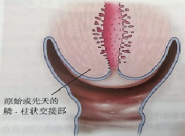 宮頸癌篩查沒那么簡單，這些技巧助你提高取樣質(zhì)量